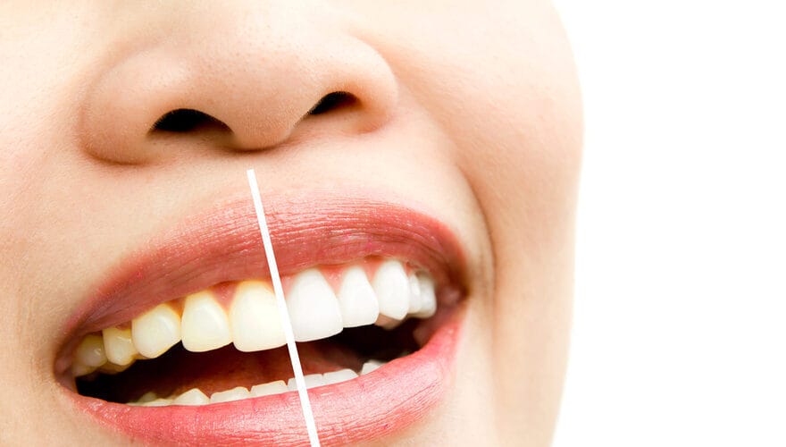 Dis beyazlatma islemi sirasinda dis hekiminin hastanin dislerine uygulama yapmasi