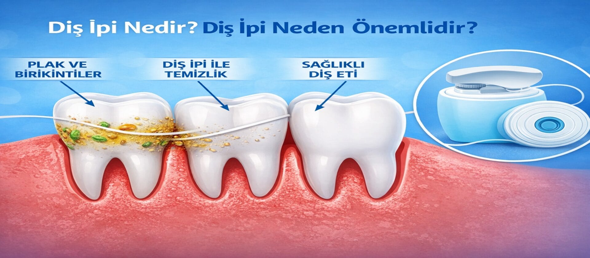 Diş ipi kullanımı ile diş aralarında biriken plak ve gıda artıklarının temizlenmesini gösteren görsel