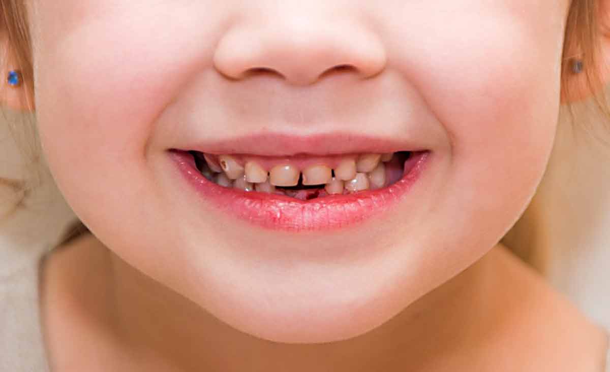 cocuklarda biberon curugu nedeniyle on dislerde olusan curukler