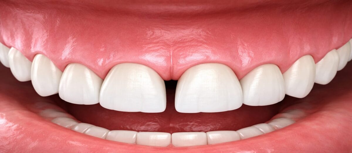 Diastema (Ayrık Diş) Tedavisi Nasıl Yapılır?