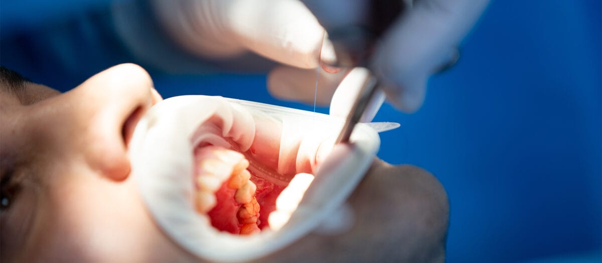 Kanal Tedavisi Nedir, Nasil Yapilir?