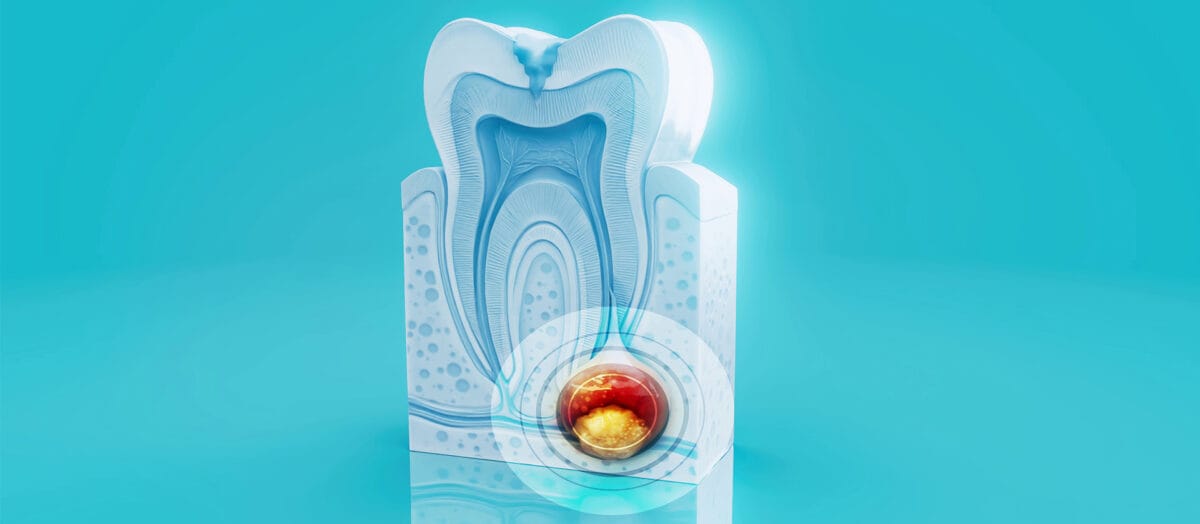 Kök Ucu Rezeksiyonu Nedir? Hangi Durumlarda Gerekir?