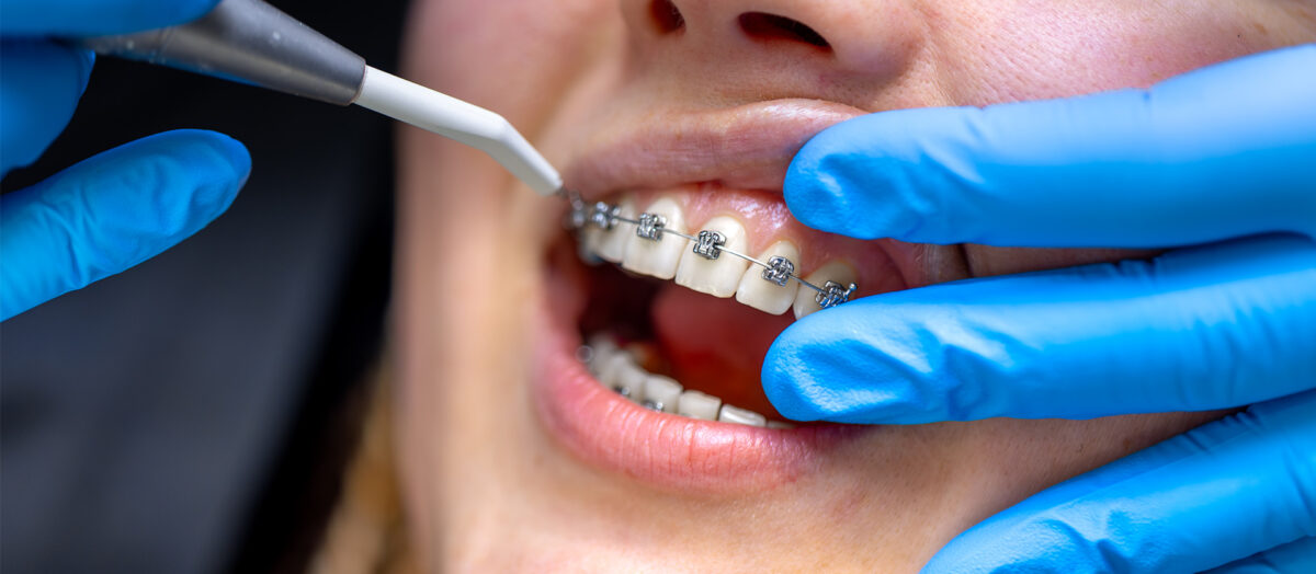 Diş Teli Ağız Bakımı: Ortodonti Sürecinde Doğru Temizlik Rehberi