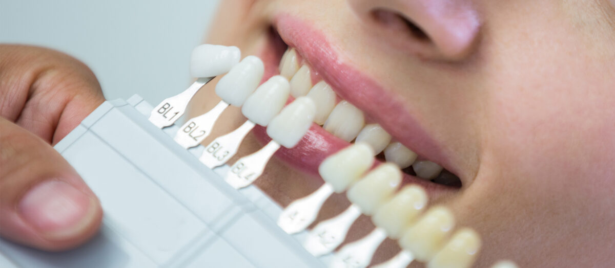 Emax Lamina Nedir? Cam Seramik Laminelerin Avantajları ve Uygulama Süreci