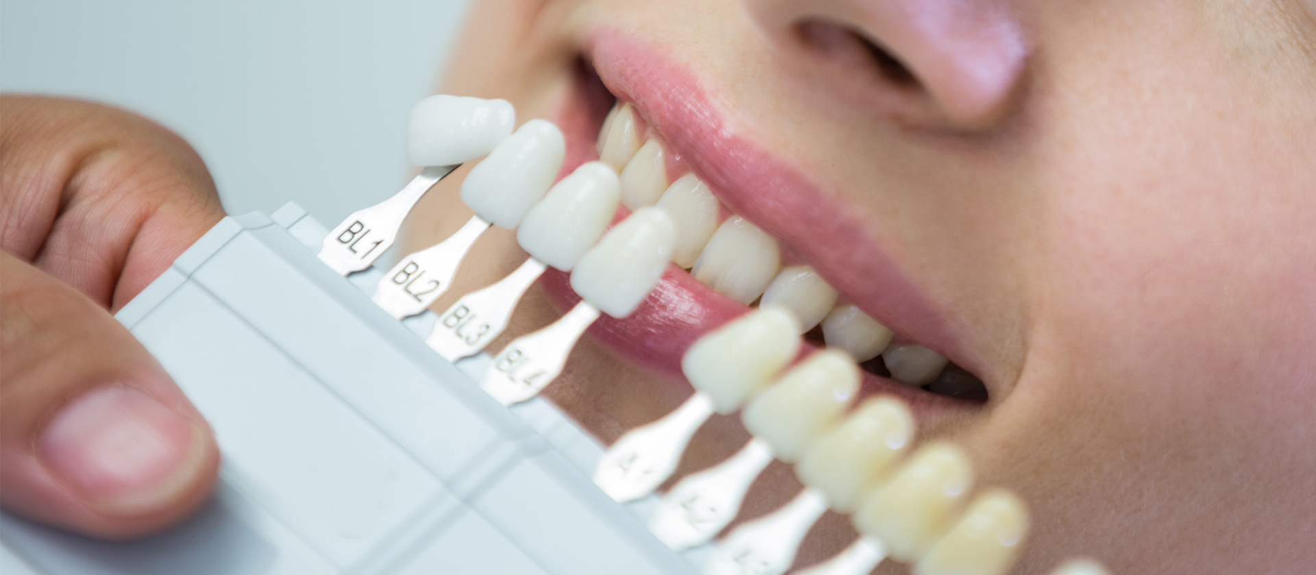 Emax laminate veneer color matching with dental shade guide