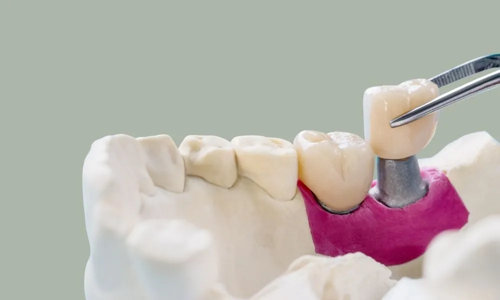 İmplant üstü protez kron yerleştirme diş implantı modeli