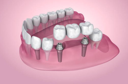 rehberli implant cerrahisi ile dijital olarak planlanan implant yerleşimi modeli
