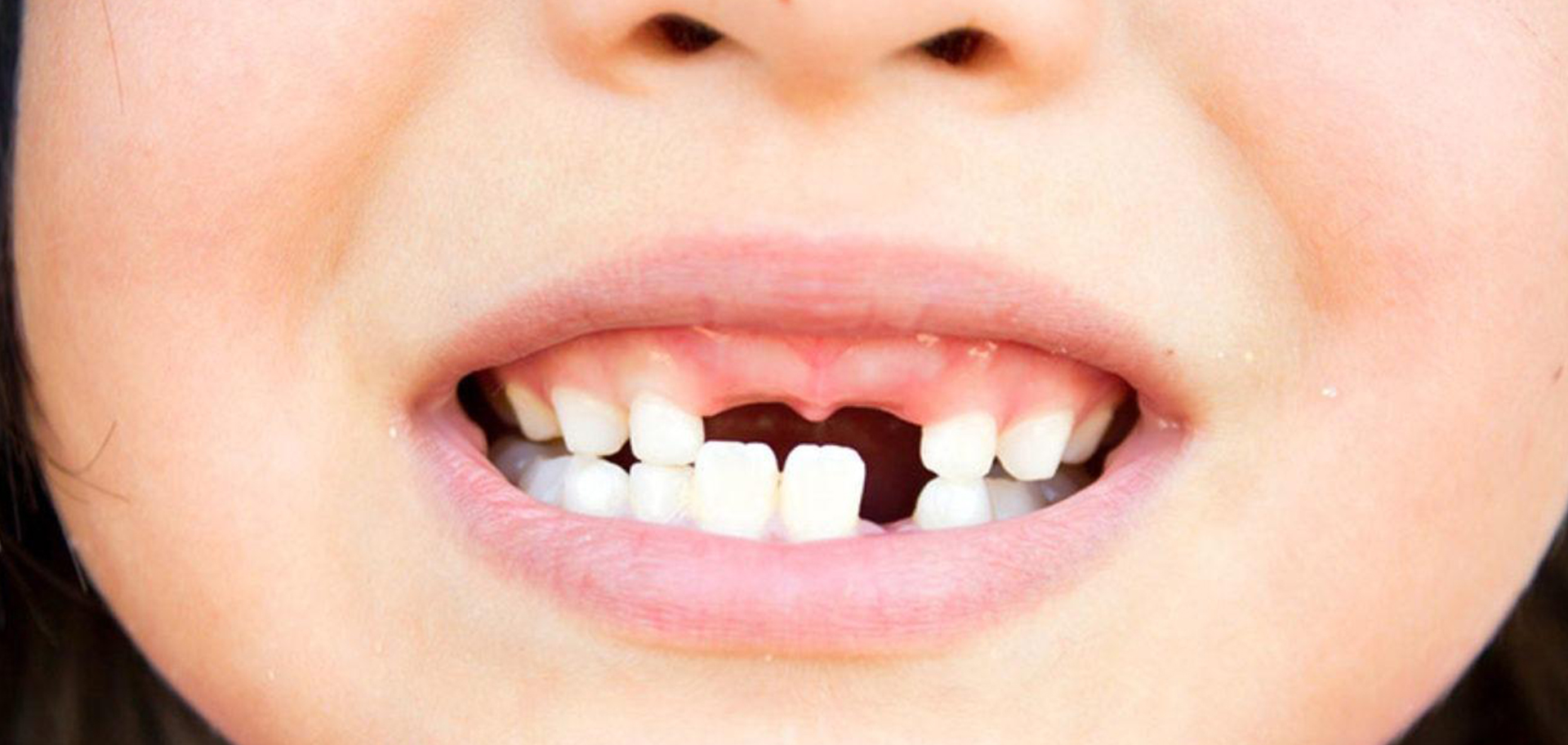 çocuklarda diş travması sonucu ön diş kaybı