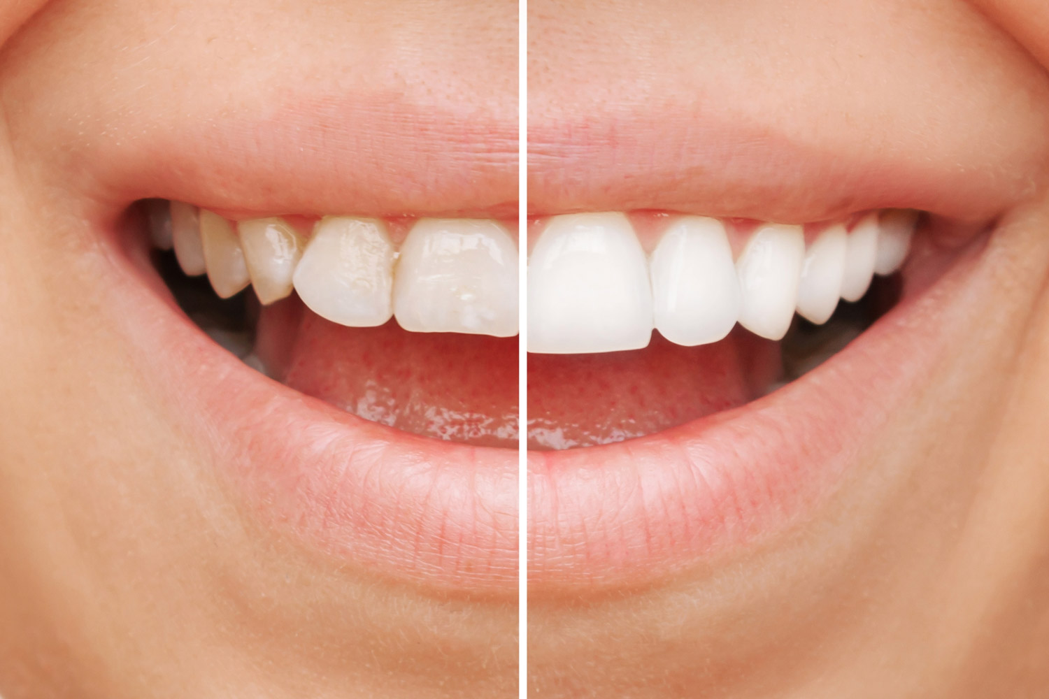 kompozit lamina tedavisi öncesi ve sonrası dişlerdeki estetik değişim